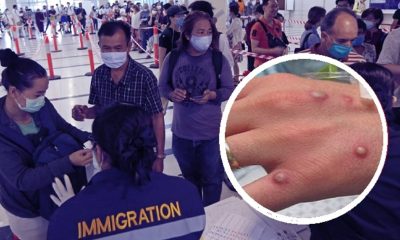 Thailand Records its 3Rd Case of Monkeypox in Phuket