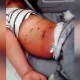 chickenpox