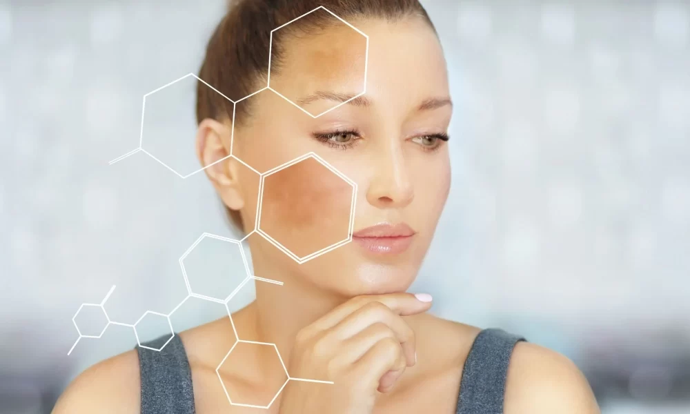Understanding Melasma and How its Treated