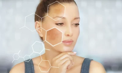Understanding Melasma and How its Treated