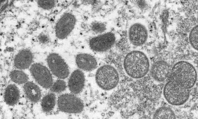 After Being Diagnosed With Monkeypox, 2 People Died