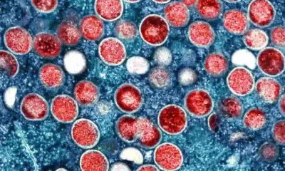 9 New Monkeypox Cases Reported In Clark County; Total Now At 270