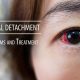 Retinal Detachment