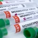 1st Monkeypox Death Announced In Chile