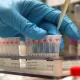 Breast Cancer Could Be Caught 2 Years Earlier With Protein Changes In Blood