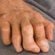 Leprosy: Chronic Disease That Regenerates Organs