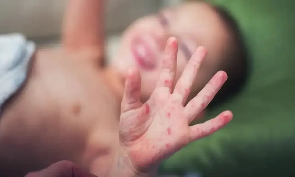 Measles Outbreak In Govandi Prompts BMC To Vaccinate 130 Kids