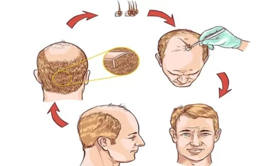 Introduction to Hair Transplant Tourism