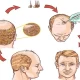 Introduction to Hair Transplant Tourism