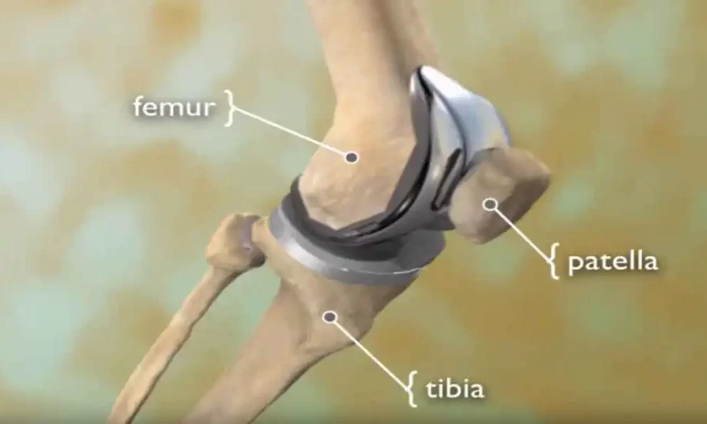 Knee Joint Replacement