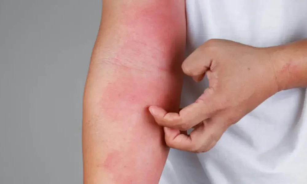 What are the most common causes of skin rashes?
