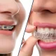 Benefits of Invisalign over Traditional Braces