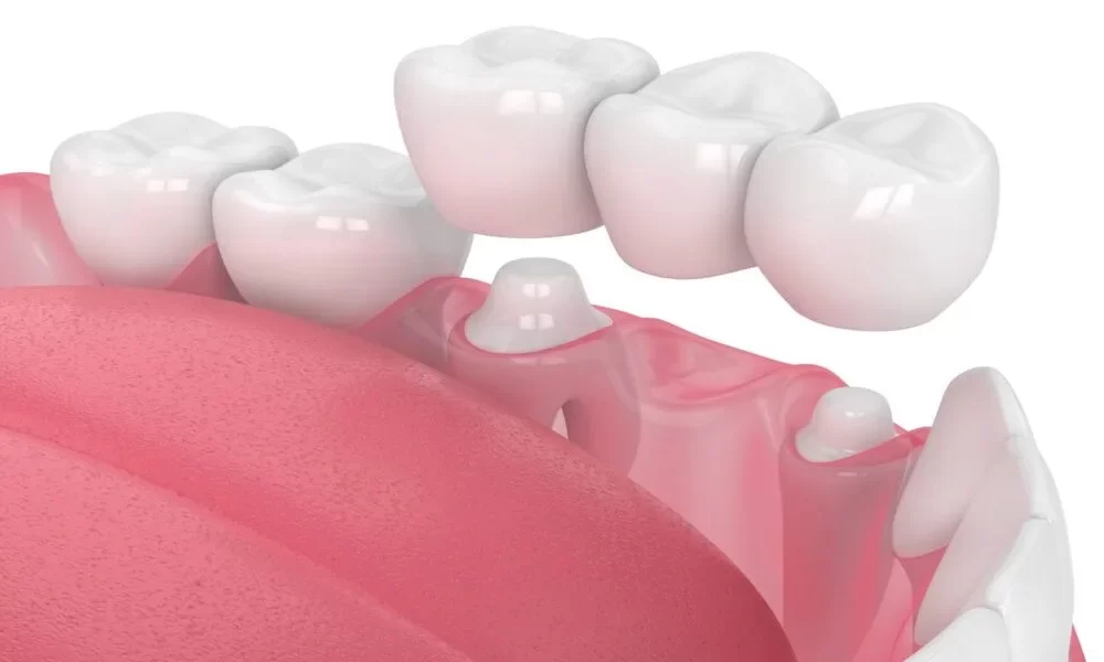 Do I Need a Dental Crown or a Bridge?