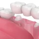 Do I Need a Dental Crown or a Bridge?