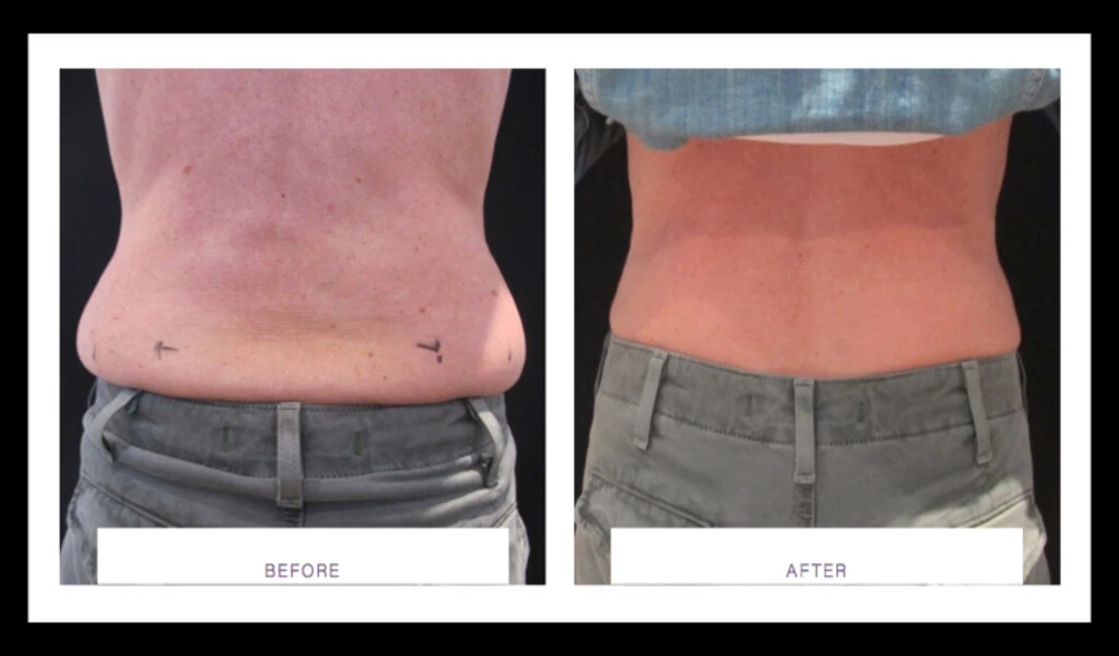 Do You Lose Weight With Fat Freezing?
