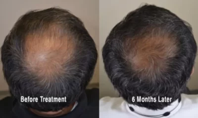 The Differences Between Topical And Oral Minoxidil