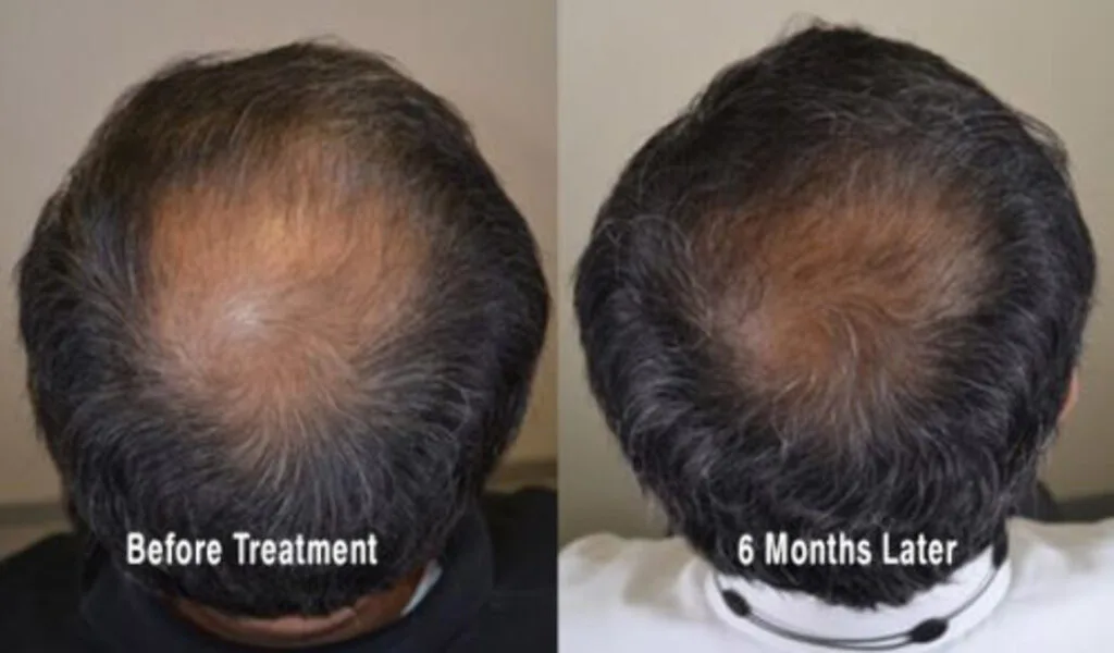 The Differences Between Topical And Oral Minoxidil