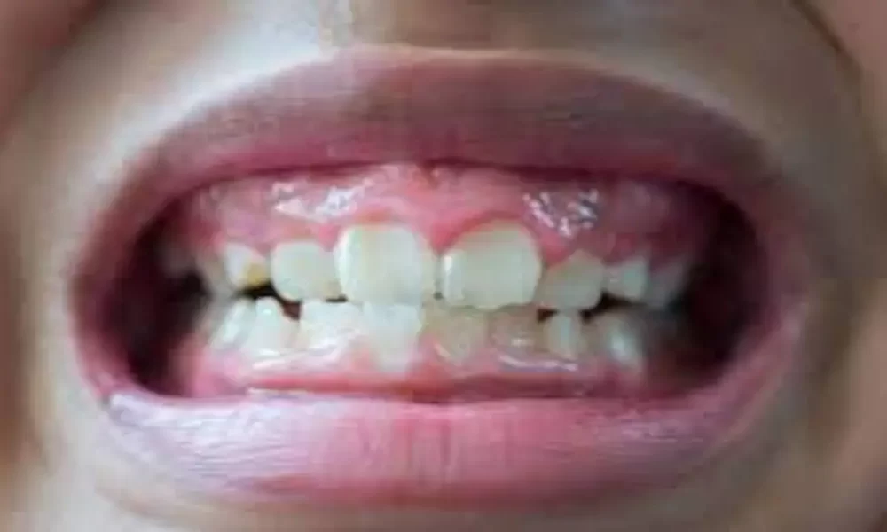 HIV And Gum Disease Study Gets Funding