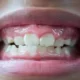 HIV And Gum Disease Study Gets Funding