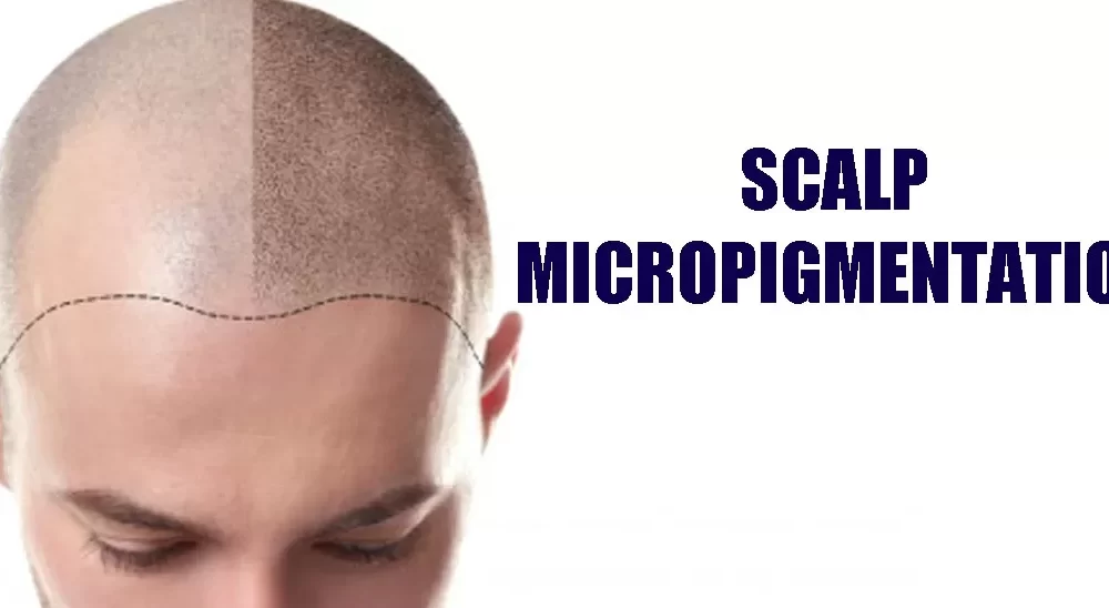 Scalp Micro Pigmentation