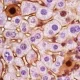 Cancer Genes Have Multiple Personalities That Can Be Identified