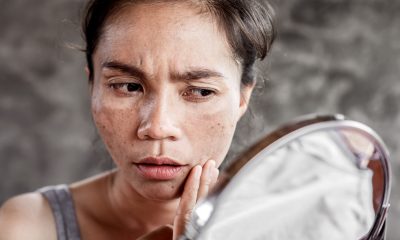 Cosmetic Dermatologist Explains 7 Ways to Treat Melasma