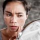 Cosmetic Dermatologist Explains 7 Ways to Treat Melasma