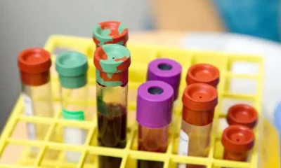 Blood Cancer And Obesity Are Linked, Researchers Find