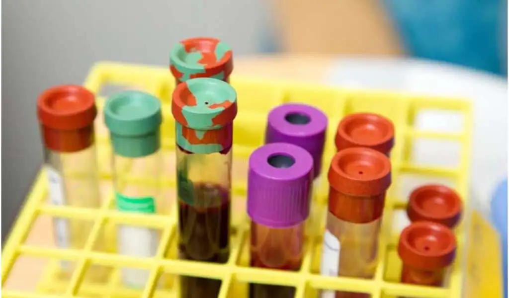 Blood Cancer And Obesity Are Linked, Researchers Find