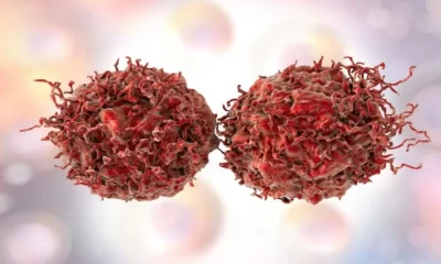 Prostate Cancer Detection Can Be Improved With Genetics
