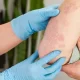 The Psoriasis In Children A Parent's Guide To Understanding