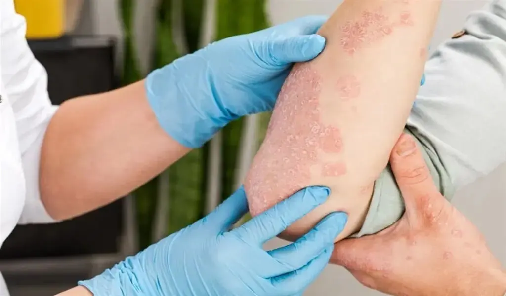The Psoriasis In Children A Parent's Guide To Understanding