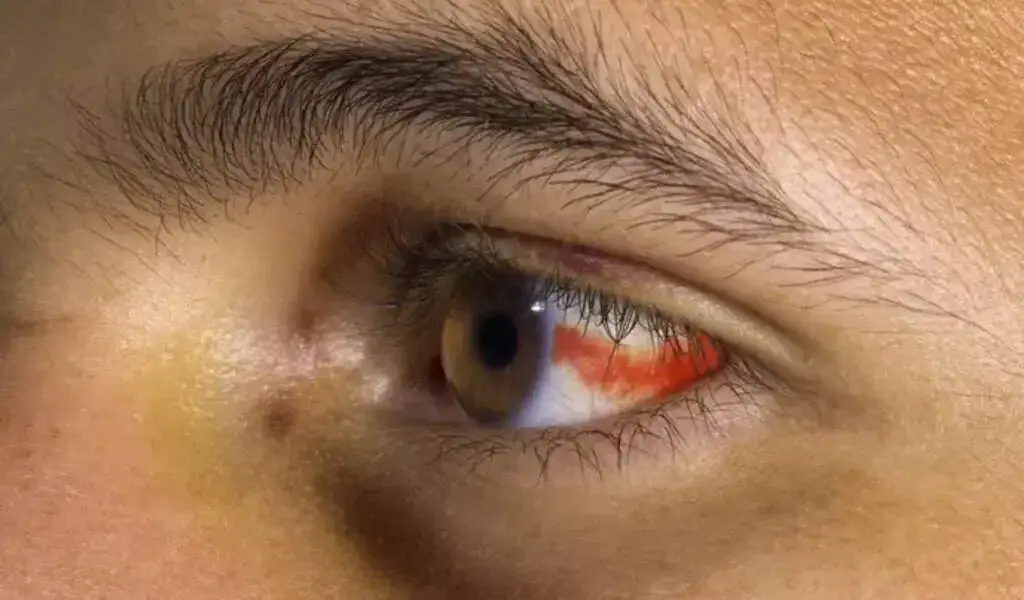 Symptoms Of Eye Bleeding, Their Causes, And How To Treat Them