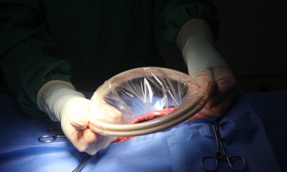 New Zealand Doctors Forget 9cm Surgical Ring Inside Woman