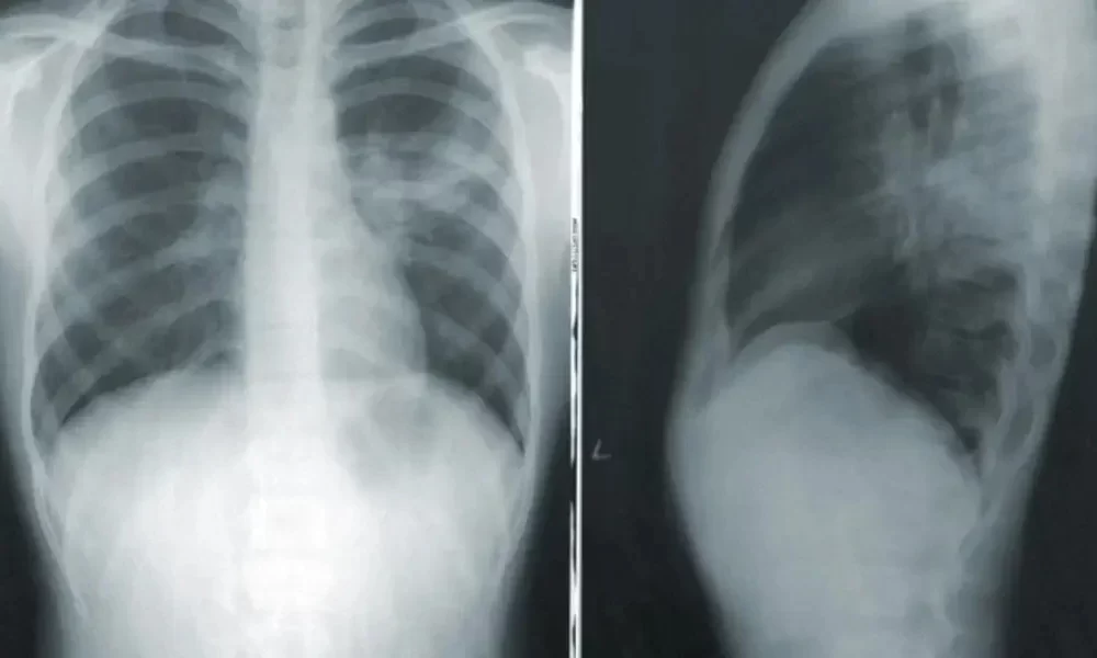 Lung Cancer Affects More Women Than Men, But No 1 Knows Why