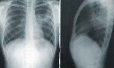 Lung Cancer Affects More Women Than Men, But No 1 Knows Why