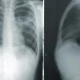 Lung Cancer Affects More Women Than Men, But No 1 Knows Why