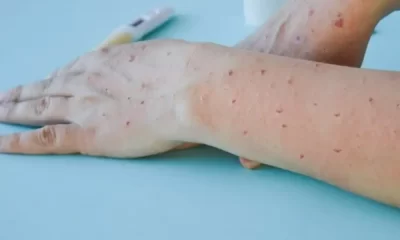 Thailand Monkeypox Outbreak