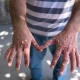 Thailand Reports 535 ‘Monkeypox’ Cases in a Year
