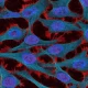 Cervical Cancer Risk Could Be Cut With Already-Approved Drugs