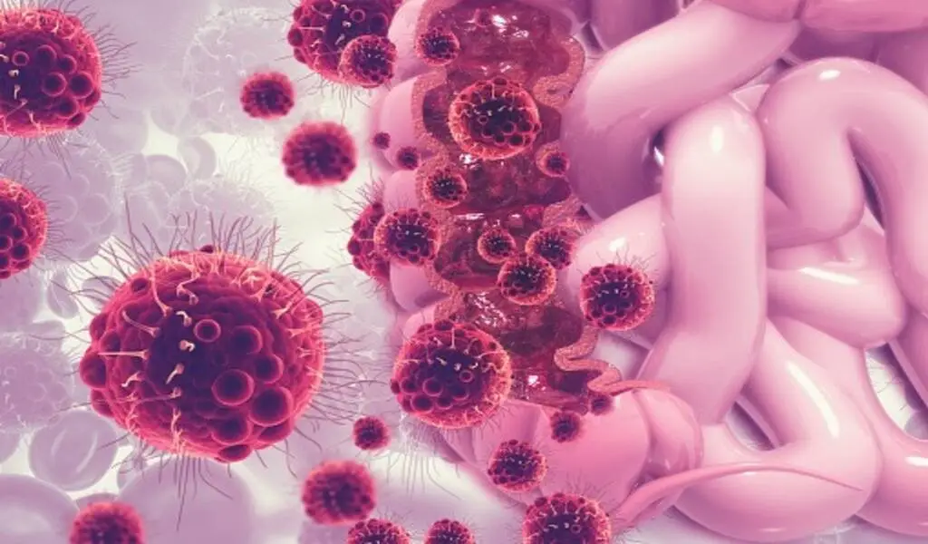 Colorectal Cancer Test Shows Promise With Multitarget RNA Test