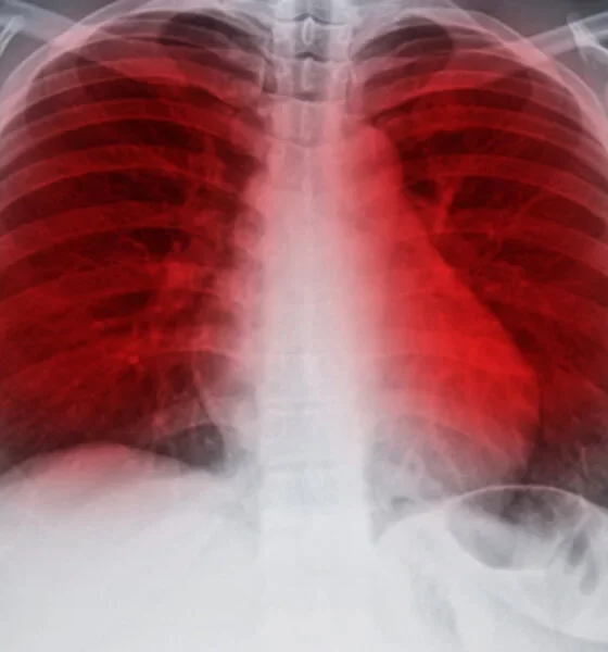 Lung Cancer Prediction Tool Versus Protein-Based Model