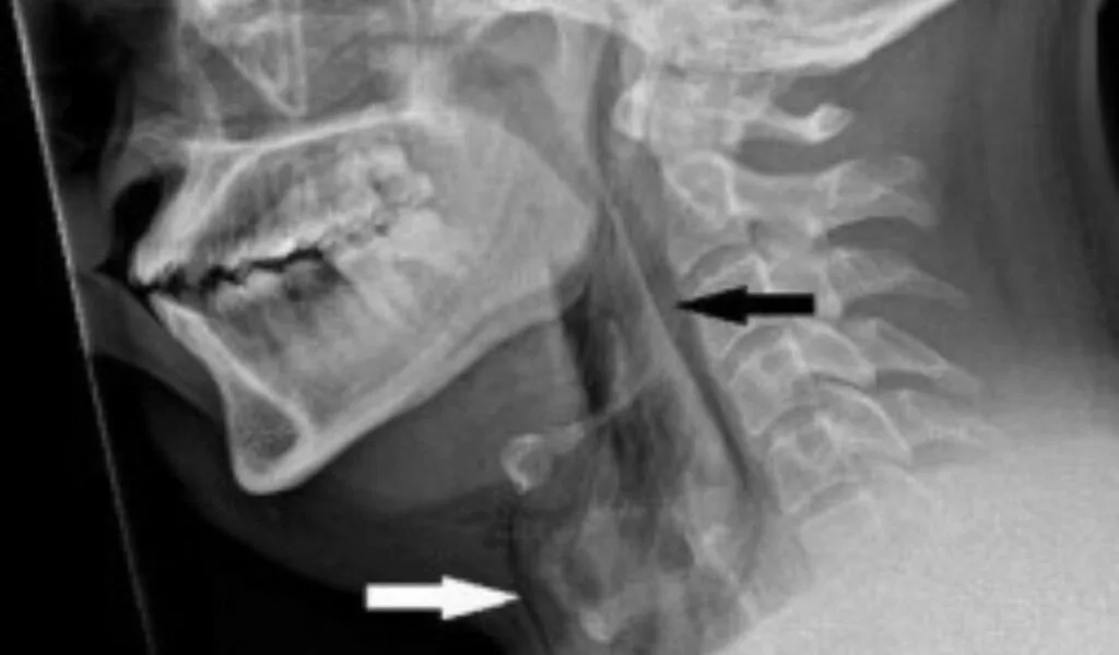 Man Hospitalized For Sneeze-Induced Throat Damage.