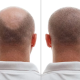 Hair Transplant