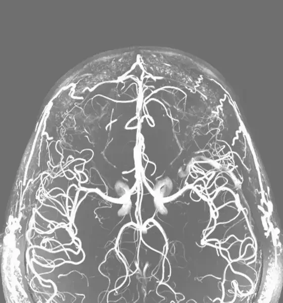 "Risk of Early-Onset Dementia is Increased By Alcohol Misuse And Loneliness."