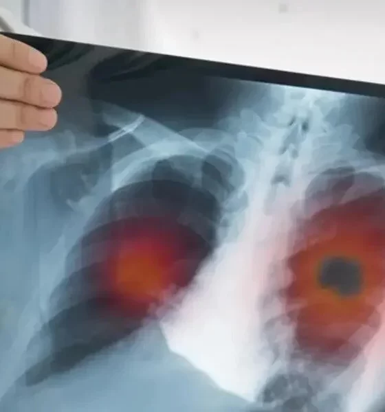 Study: Lung Cancer Pill Reduces Death Risk By 50%.