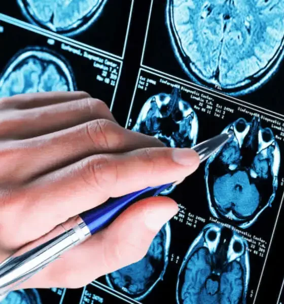 Can Alzheimer’s Disease Be Transmitted Between Humans? Exploring Myths, Genetics, and Prevention Strategies