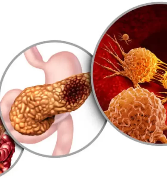 Early Signs and Management of Pancreatic Cancer Explained