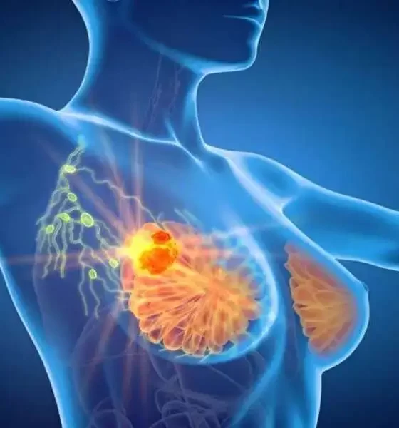 Breast Cancer Exams Rarely Detect Second Cancers After DCIS