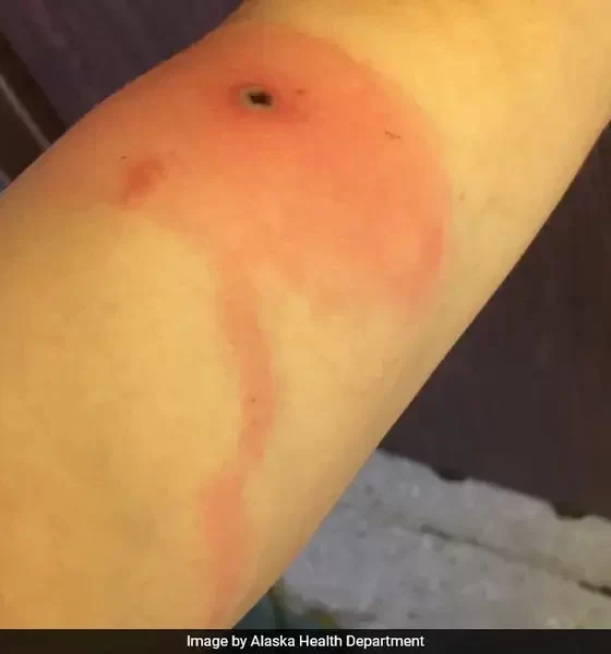 Alaskapox, The Viral Disease That Killed a Man In The US